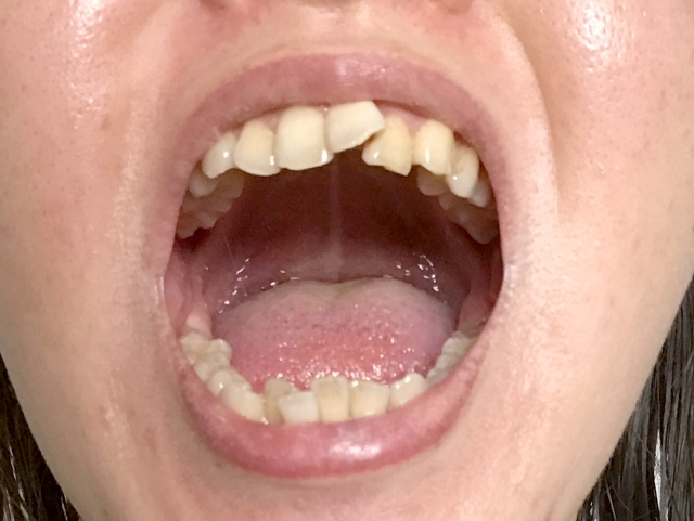 亀戸でマウスピース矯正なら矯正歯科はアルファー歯科